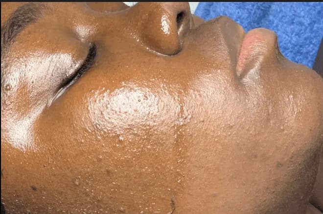 Acne Facial Treatment