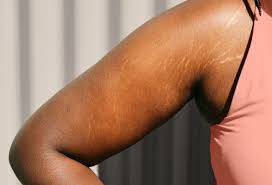Stretch Mark Removal